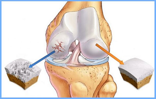 Articulación de rodilla normal y afectada por osteoartritis. 