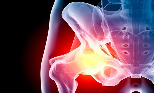 Osteoartritis de la articulación de la cadera
