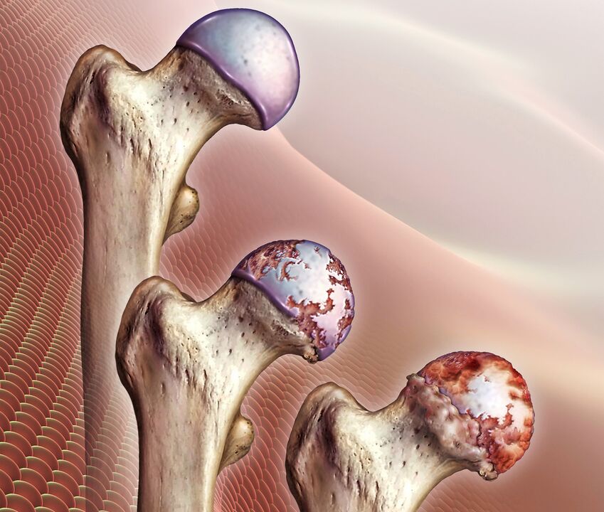 El desarrollo de la osteoartritis de la articulación de la cadera. 