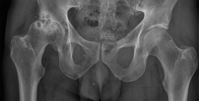 Radiografía de artrosis deformante de la articulación de la cadera. 