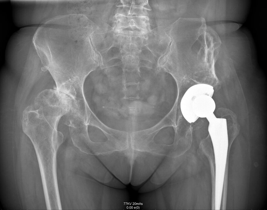 Radiografía de la articulación de la cadera después de la endoprótesis. 