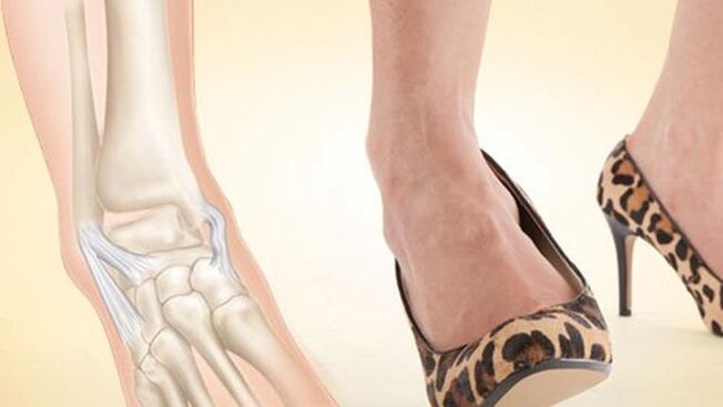El uso de tacones como causa de artrosis de tobillo