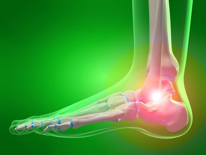 Inflamación del tobillo con artrosis