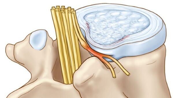 La osteocondrosis lumbar puede provocar complicaciones en forma de hernia intervertebral. 