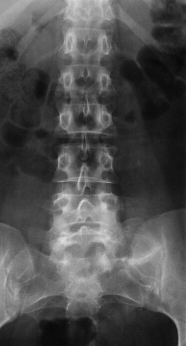 Para diagnosticar la osteocondrosis lumbar, se realiza una radiografía. 