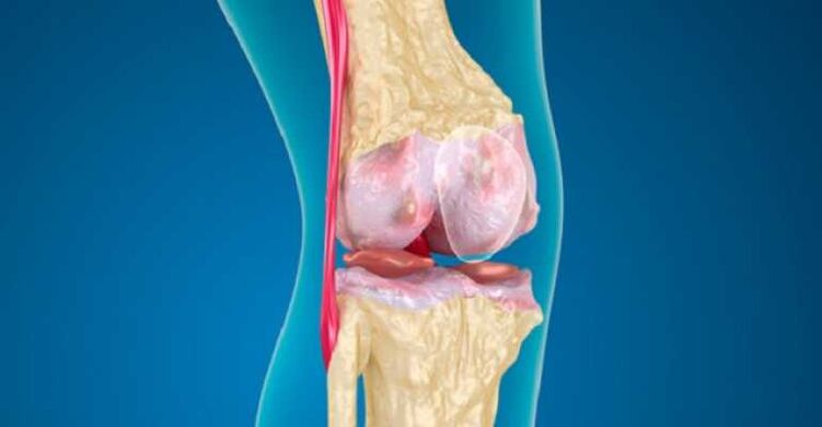 Artrosis de la enfermedad de la rodilla, lo que causa la destrucción del cartílago en las articulaciones