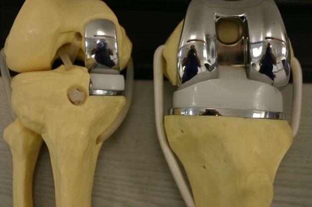 Reemplazo de rodilla por osteoartritis