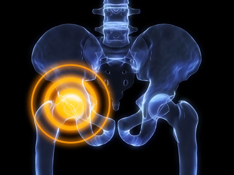 Osteoartritis de la articulación de la cadera